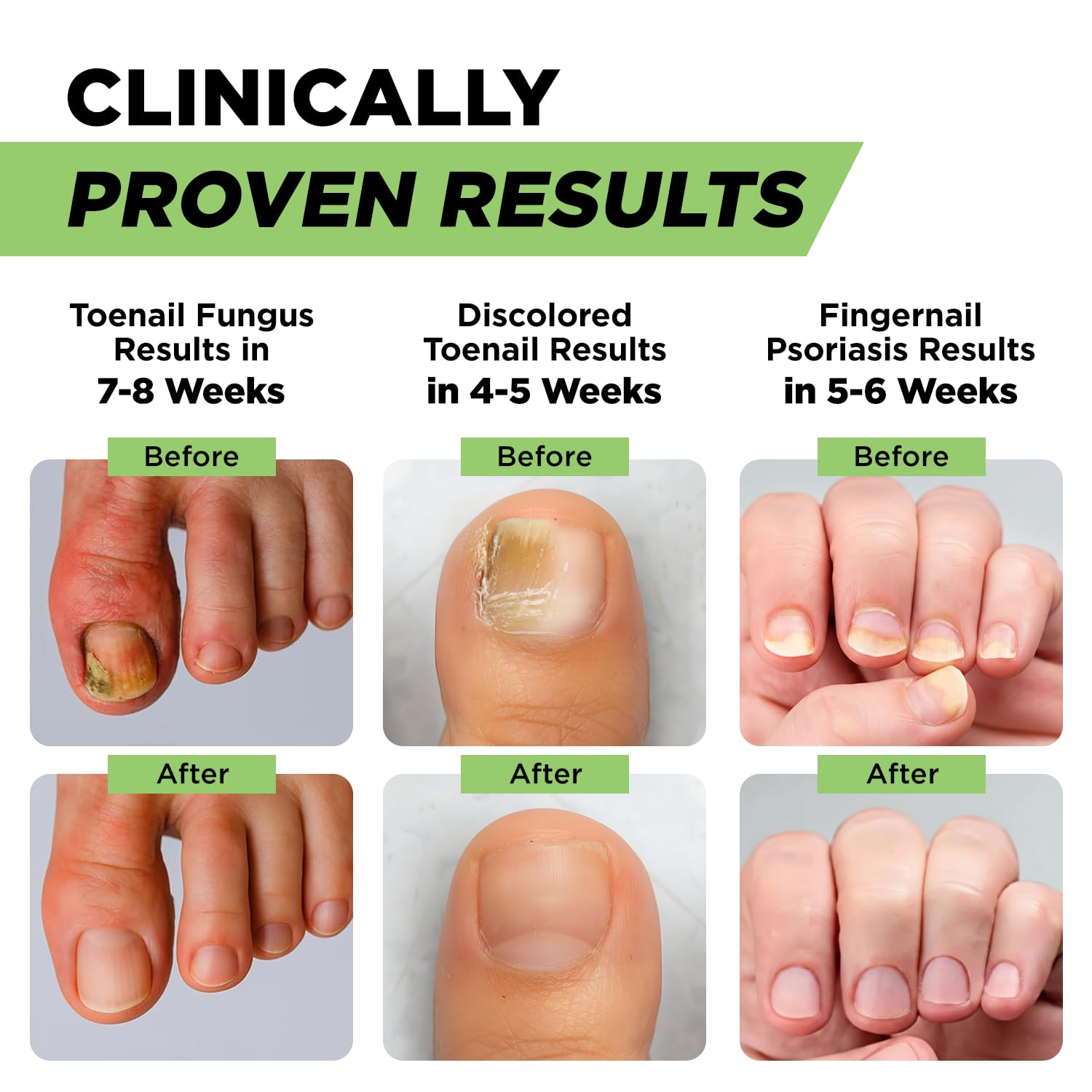 Footcure Antifungal Nail Treatment Pen with 25 percent undecylenic acid tea tree oil and oregano oil for toenail and fingernail care
