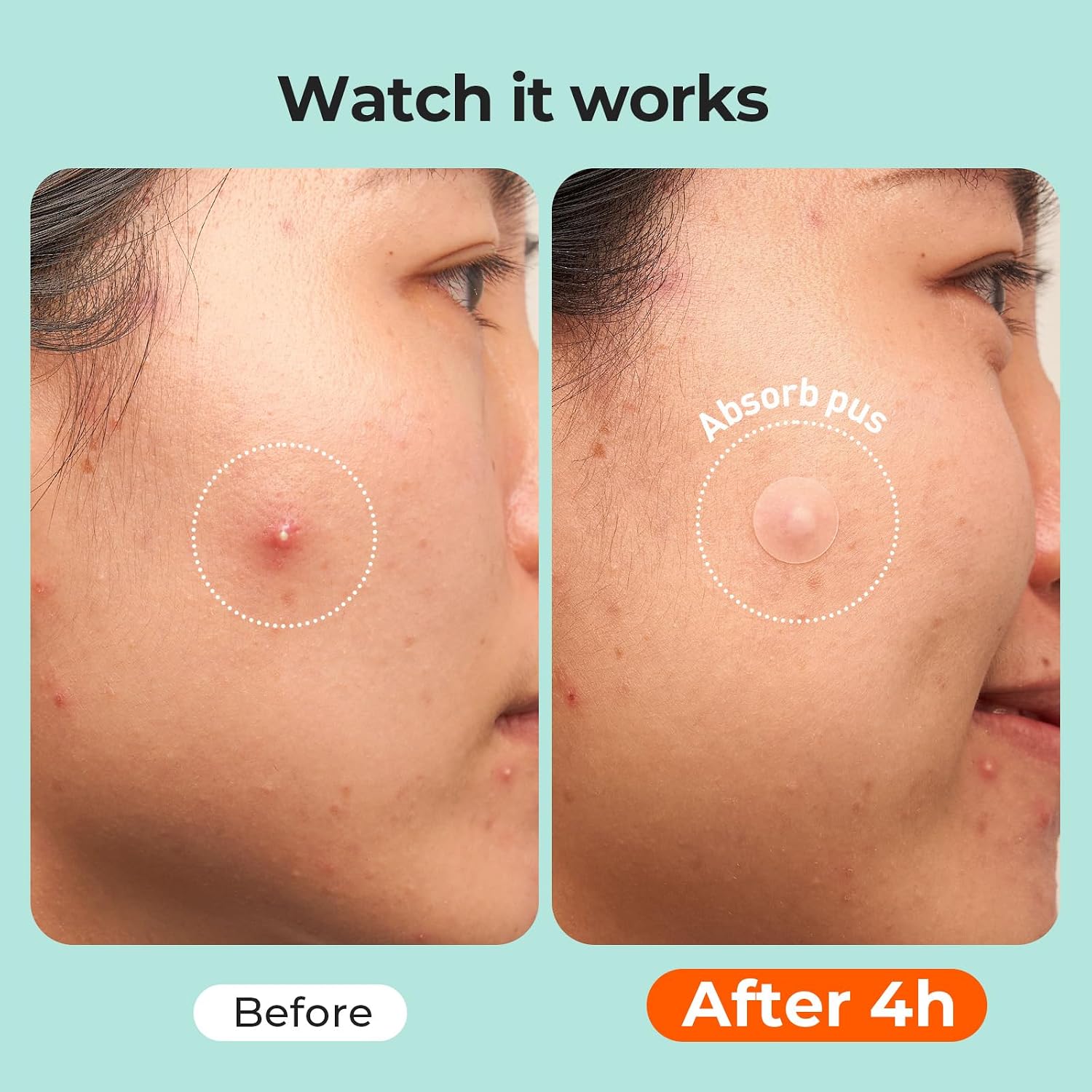 TKTK 443 Count Pimple Patches for Face Hydrocolloid Acne Cover Patch Bulk
